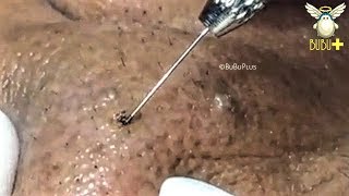 Spots, cystic acne and blackheads removal acne treatment 191212! Spots, cystic acne and blackheads removal acne treatment 191212!