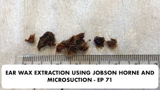Ear wax extraction using jobson horne and microsuction - ep 71 Ear wax extraction using jobson horne and microsuction - ep 71